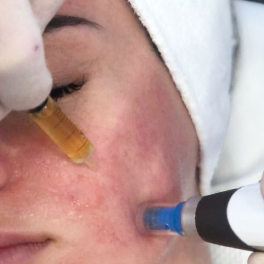 SkinPen Elite Series (3 Treatments) at Serene.Esthetics in Franklin Square, NY