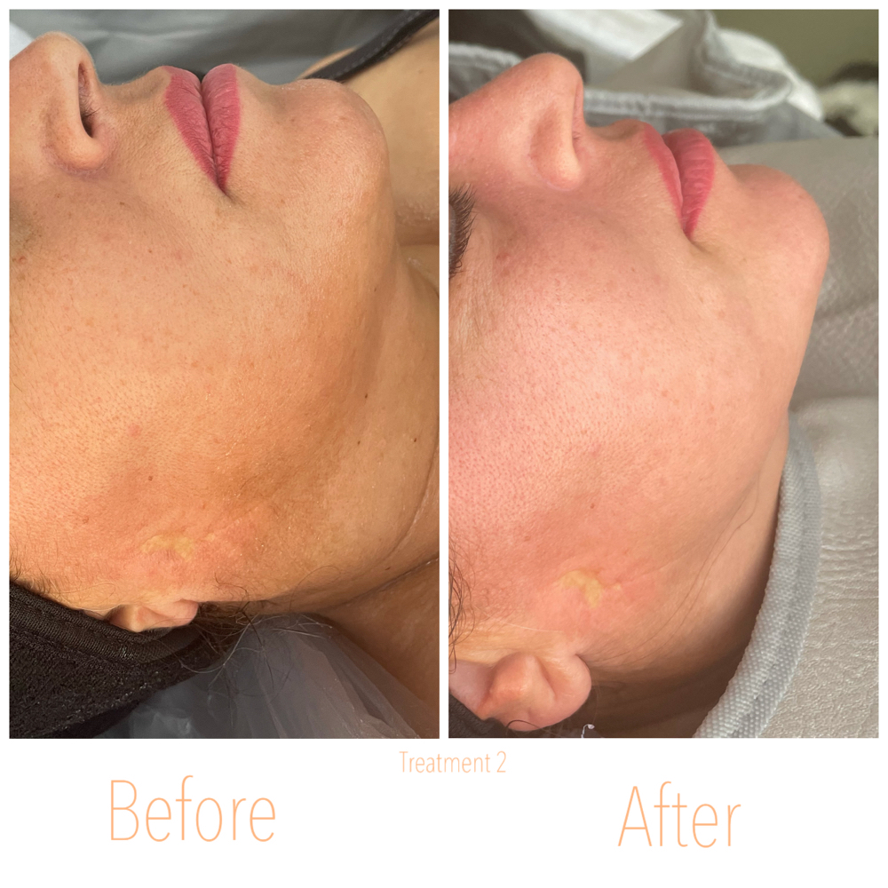 Chin & Jaw Contouring