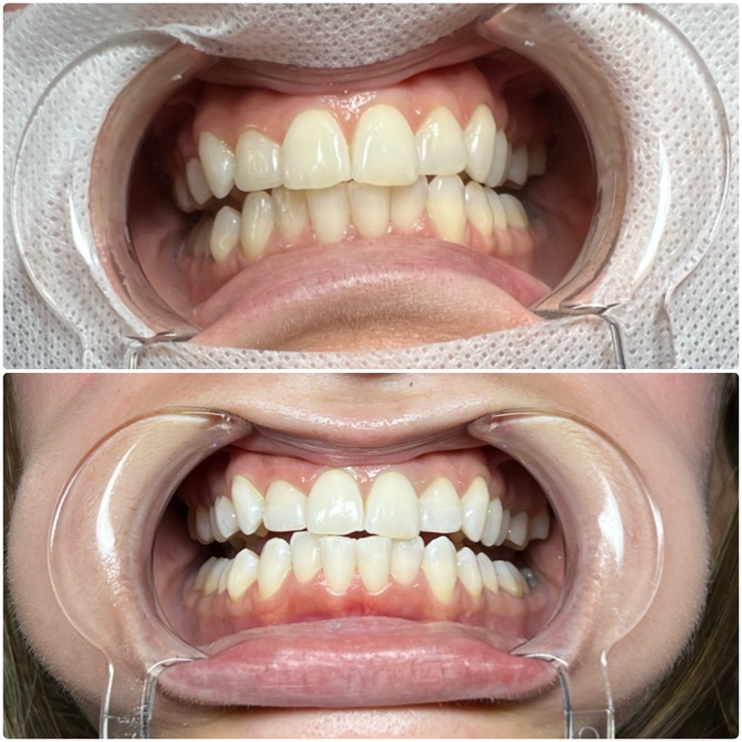 Express 30 Min Whitening at True artist studio in Goose Creek, SC