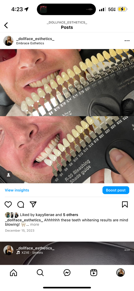 50$ FLASH SALE TEETH WHITENING