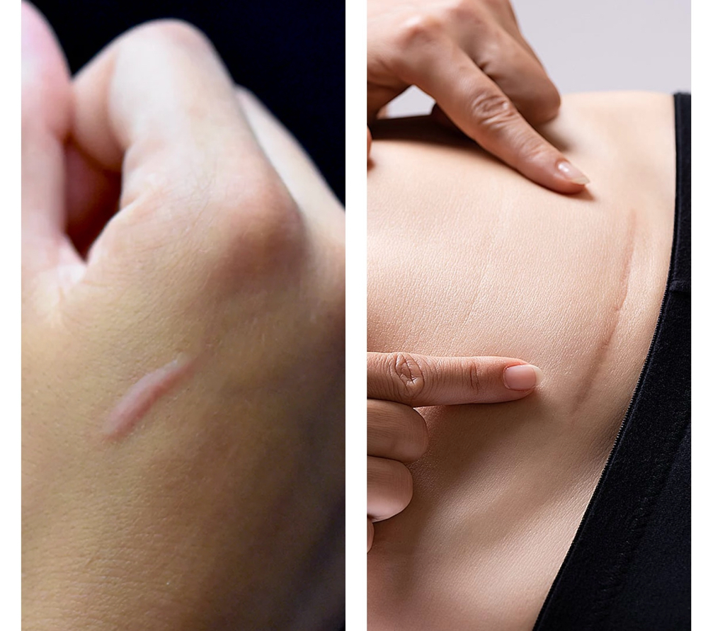 Nue Conceal Scar Treatment