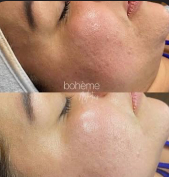 Dermaplaning