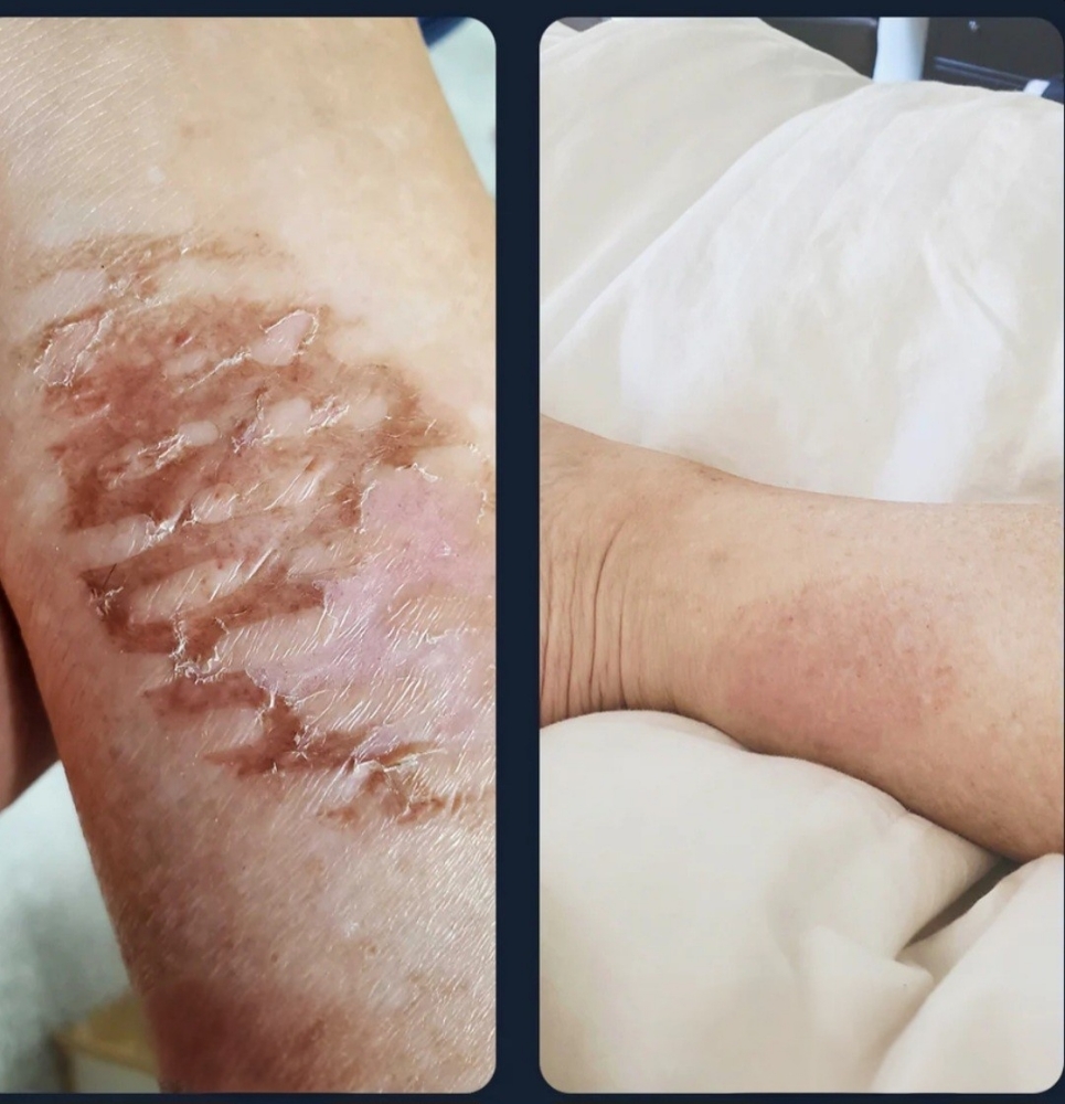 Skin Health Treatment