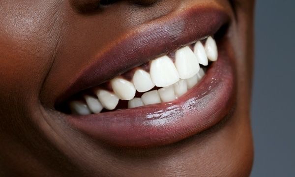 Teeth Whitening Treatment