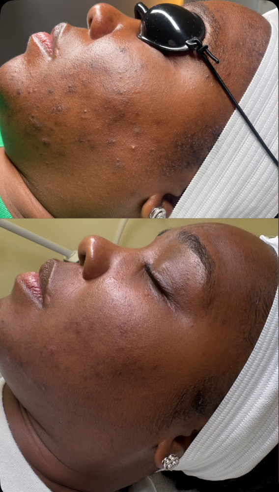 Acne Bootcamp Package (6 Sessions)