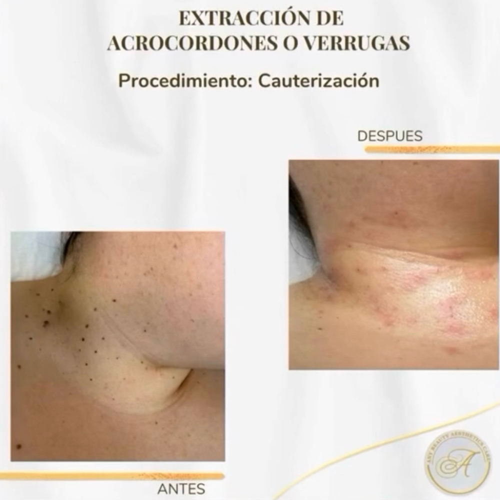 Remocion De Verrugas at Any Beauty Aesthetics Care in New York, NY
