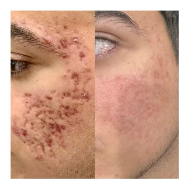 Acne Revision at Cosmetic Studio 54 in Los Angeles, CA