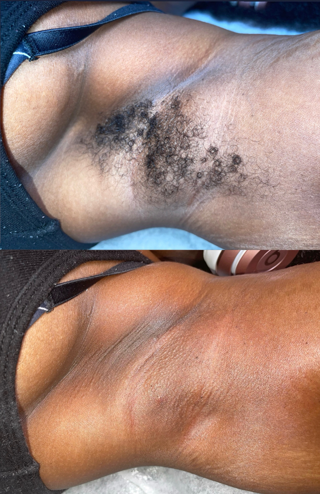 ZER0 = UNDERARM HAIR [UNISEX]™