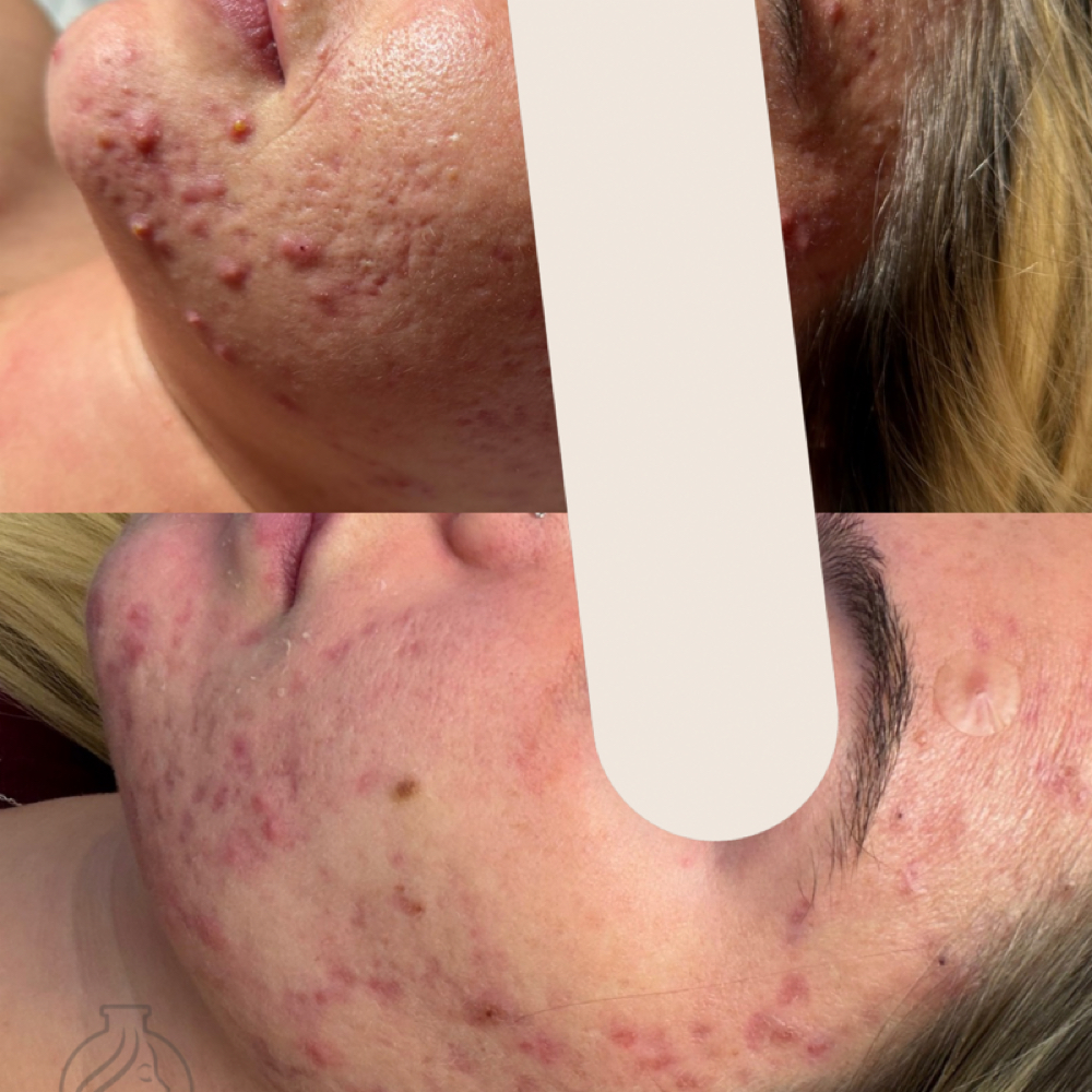 Clear Skin- Follow Up at FabWithTabb in Springfield, MO