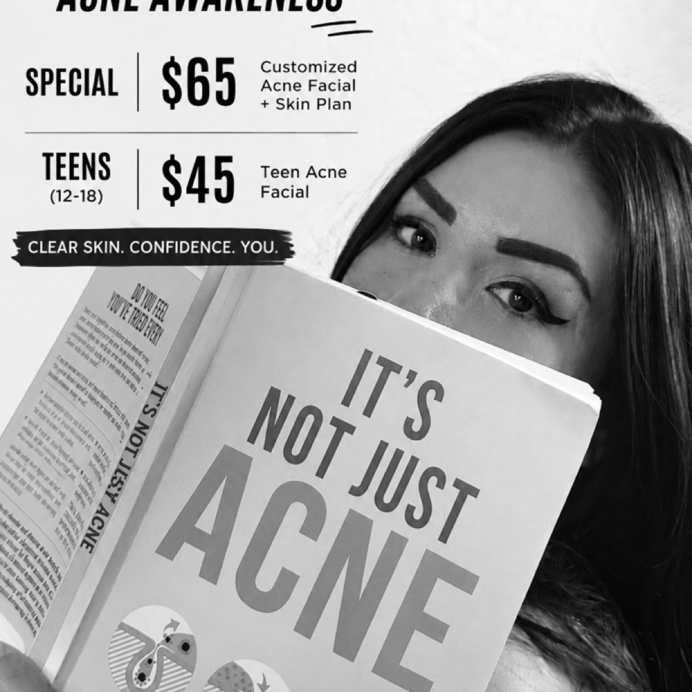 Acne Facial at Studio 86 in Hanford, CA