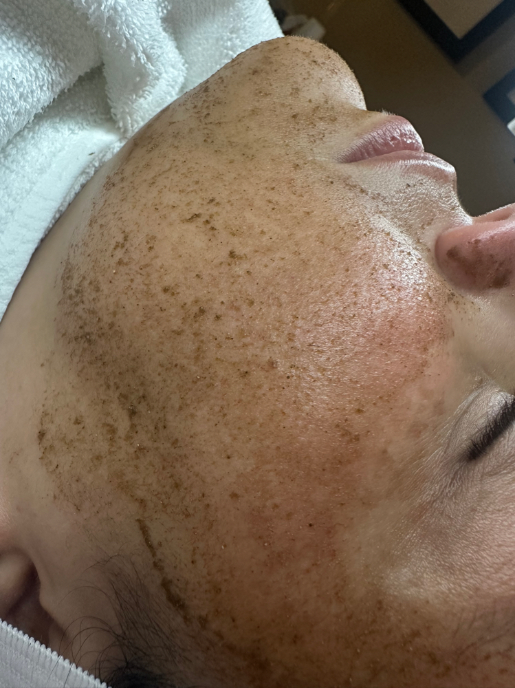 Liquid Microneedling