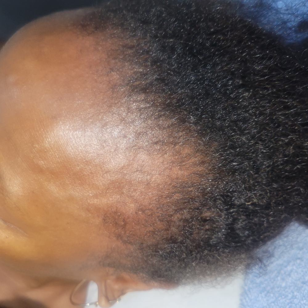 Hair Loss Restoration