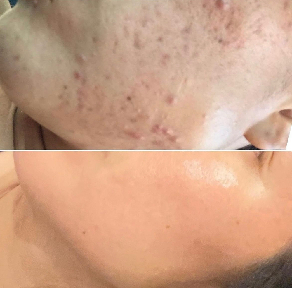 Acne Custom Signature Facial