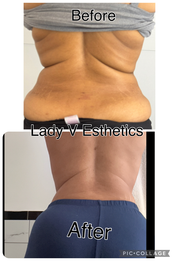 Fat Dissolving Injections Round 1