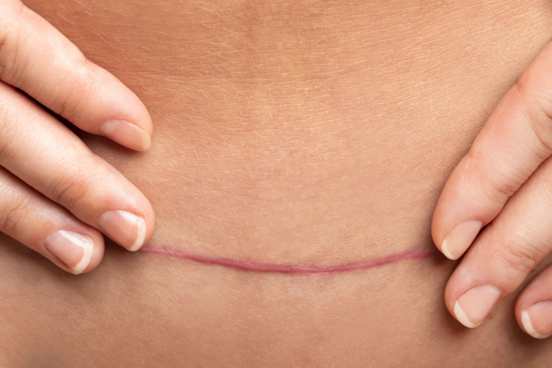 PRP Scar Rejuvenation