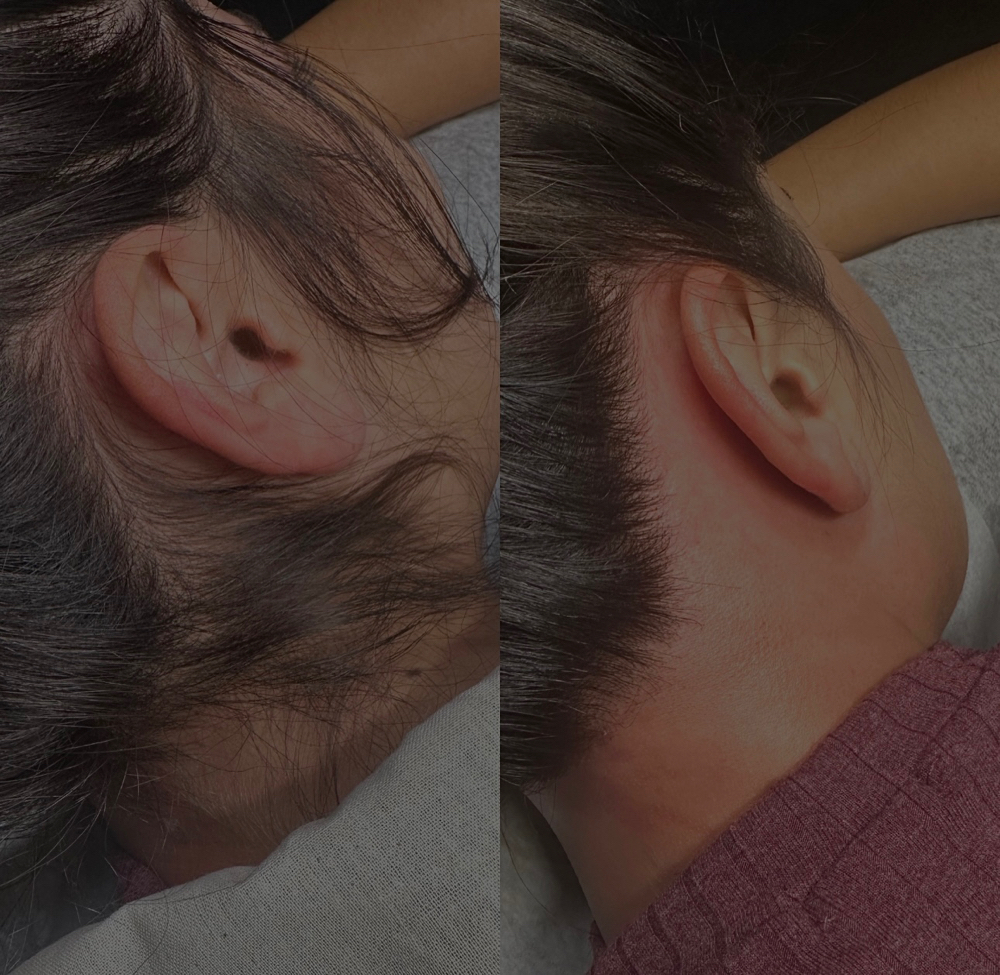 Nape of Neck