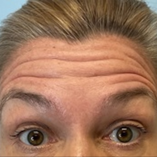 Tox- Botox at Monogram Med Spa in Harrisonburg, VA