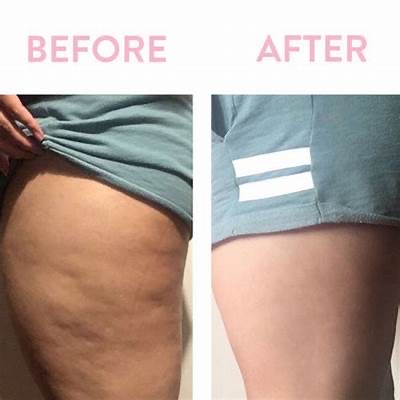 Derma-smooth Cellulite Treatment