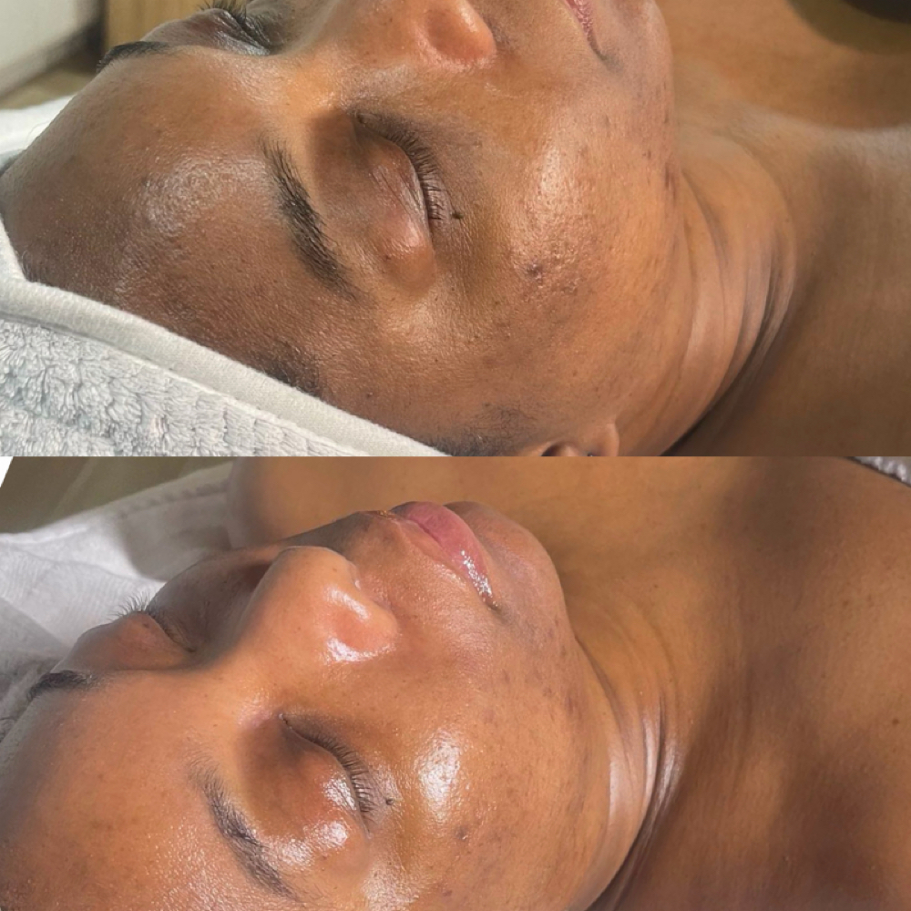 Level II Chemical Peels at Radiance Aesthetics by Aracely in Bakersfield, CA