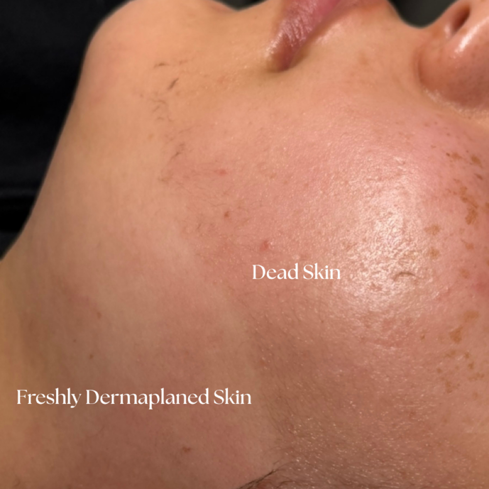 Dermaplane at True Beauty Esthetics in North Platte, NE