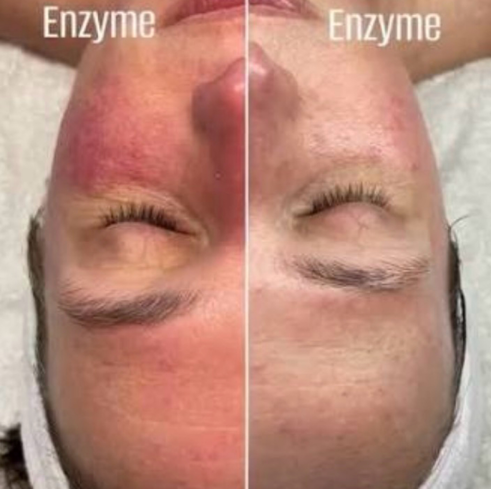 Enzyme Treatment at Skin By Shelly in Port Washington, WI