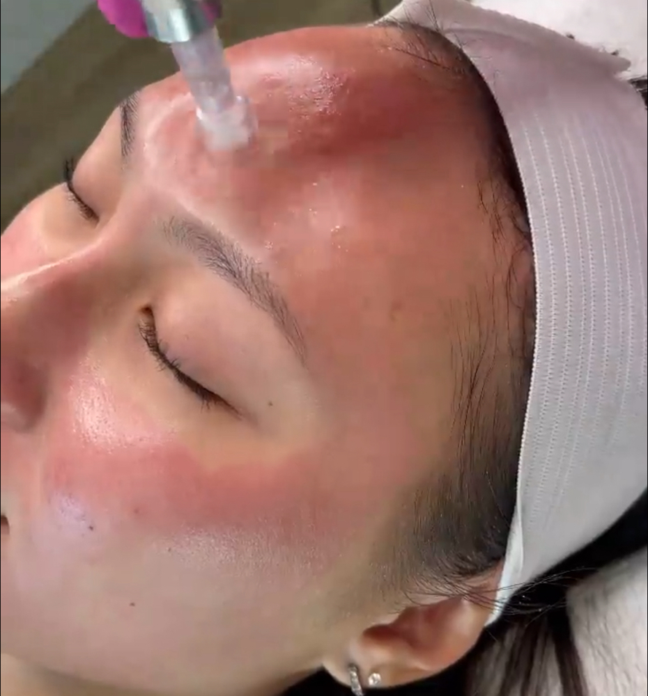 Micro Needling Facial at Tiny Touch up’s,LLC in Palm Springs, FL