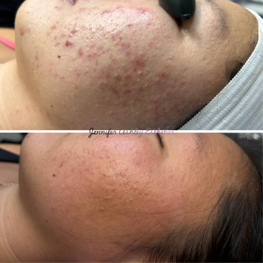 Clear Agenda - Acne Program at Jennifer Ashley Esthetics in Seminole, FL