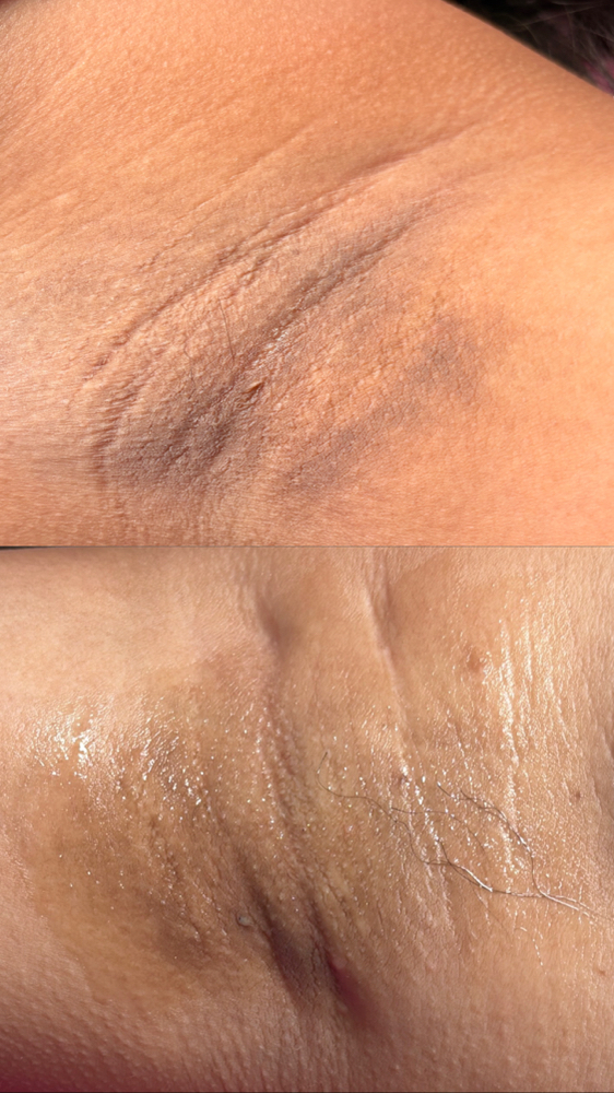 Underarm Skin Lightening at Bare With Me in Upland, CA
