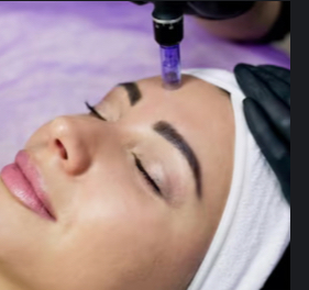 MICRONEEDLING + MD P.E.A.R.L.