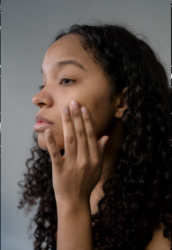 Chemical Peel