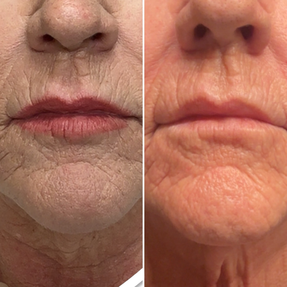 Fine Line & Wrinkles: Lower Under Eyes To Jawline