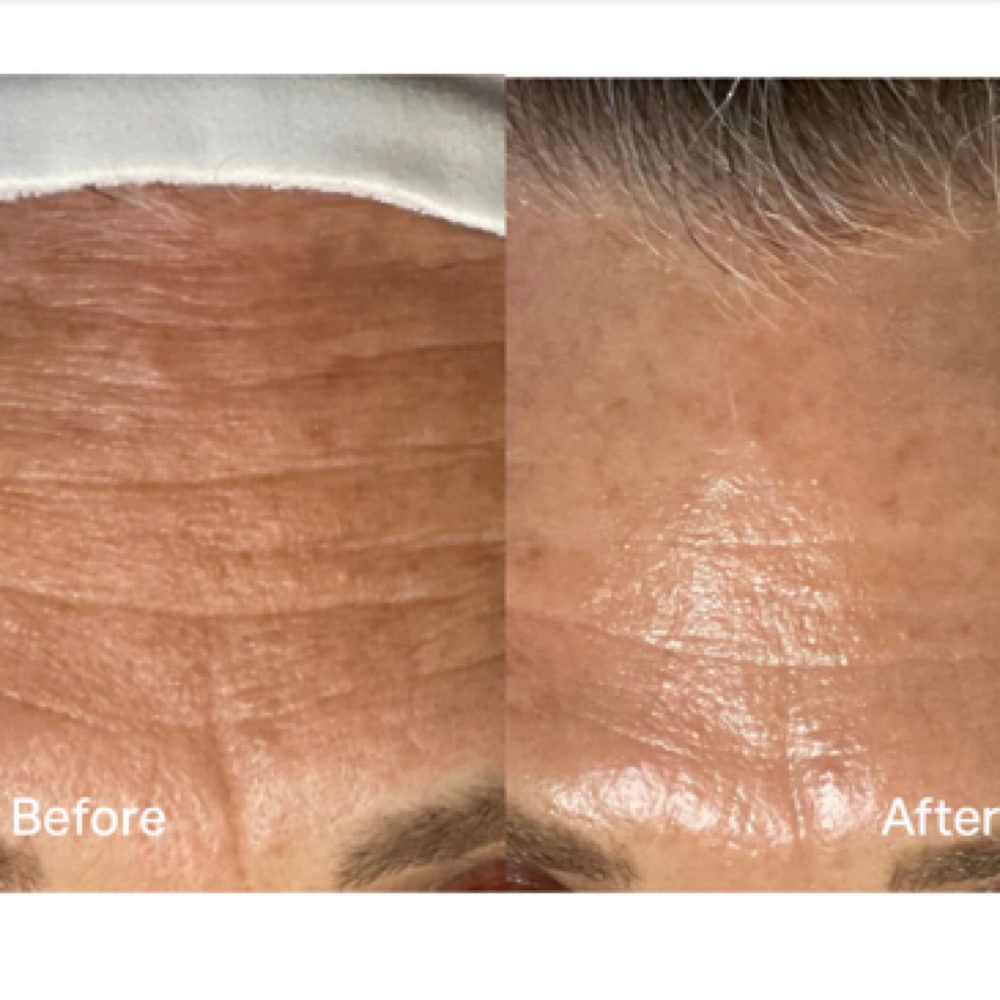 Platinum HydraFacial at Cura Viso Aesthetics in West Chester, PA