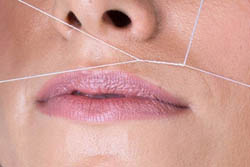 Upper Lip Thread