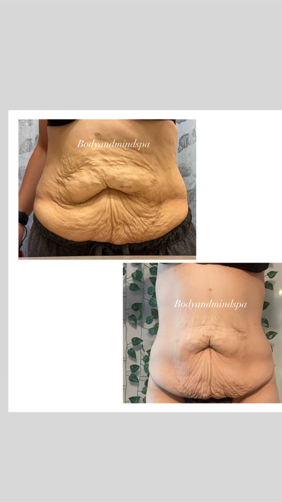 New Skin Tightening