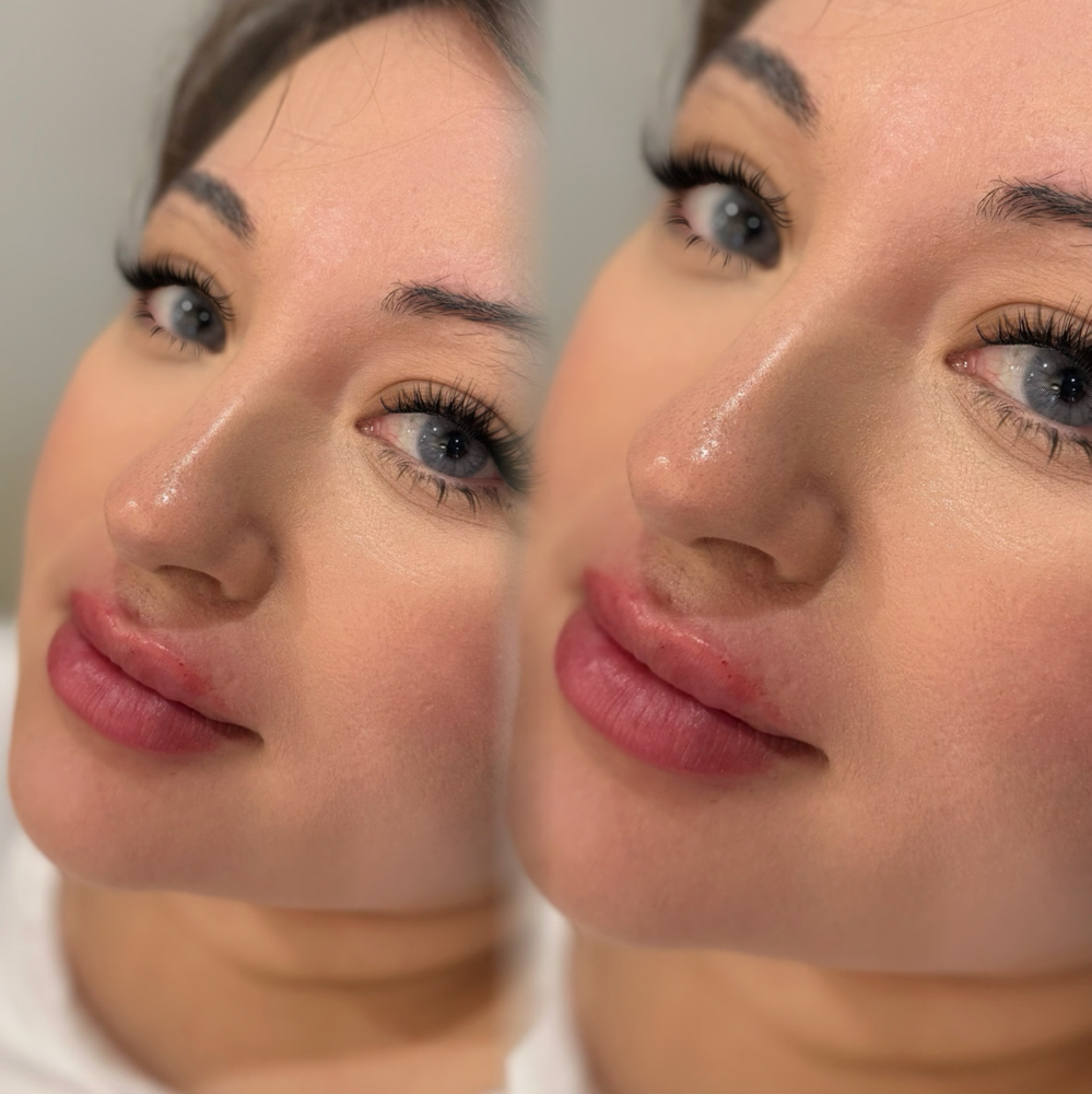 LIP Filler MODELS