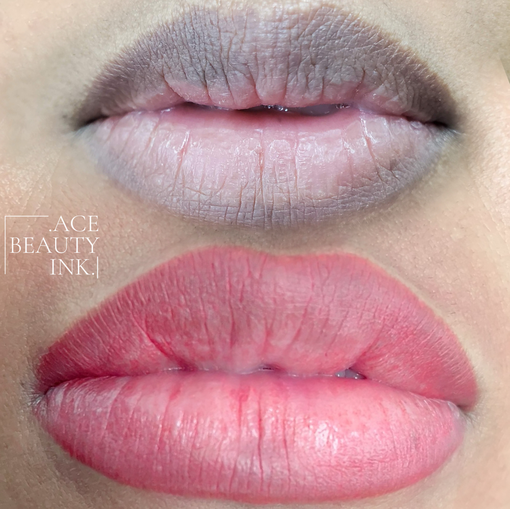 Dark Lip Neutralization