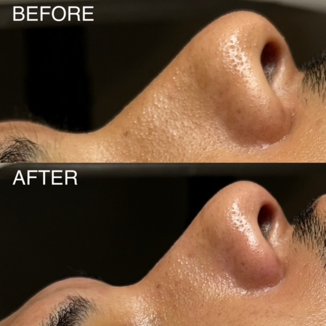 Extraction Add on at BK Skin & Brow Co. in Saint Charles, IL