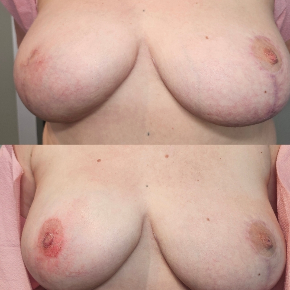 Bilateral Areola Tattoo at Aligned Beauty & Wellness in Davenport, IA