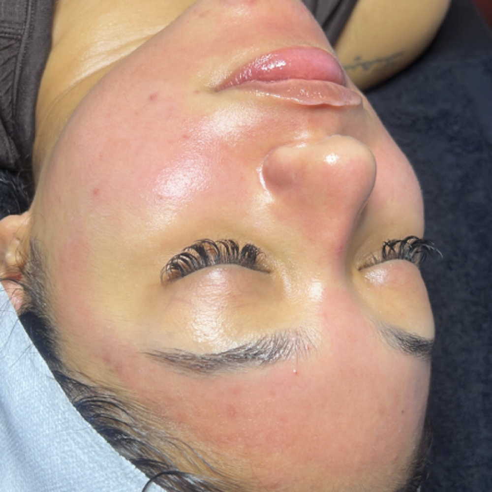 Microneedling With Hyaluronic Acid at Elite Beauty And Beyond in Worth, IL