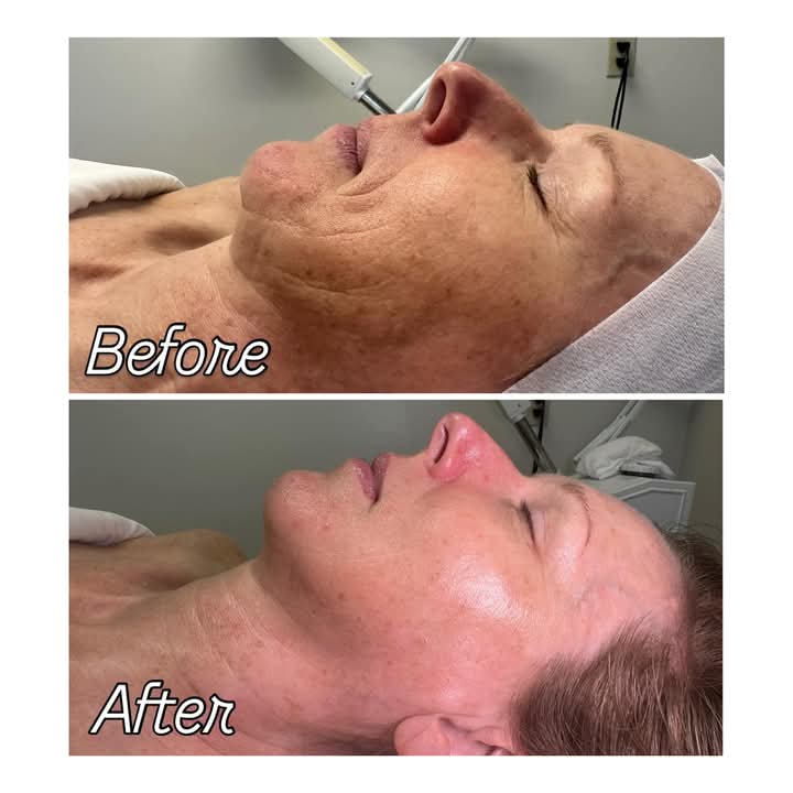 Anti-Aging Facial at ReNew in Fort Lauderdale, FL