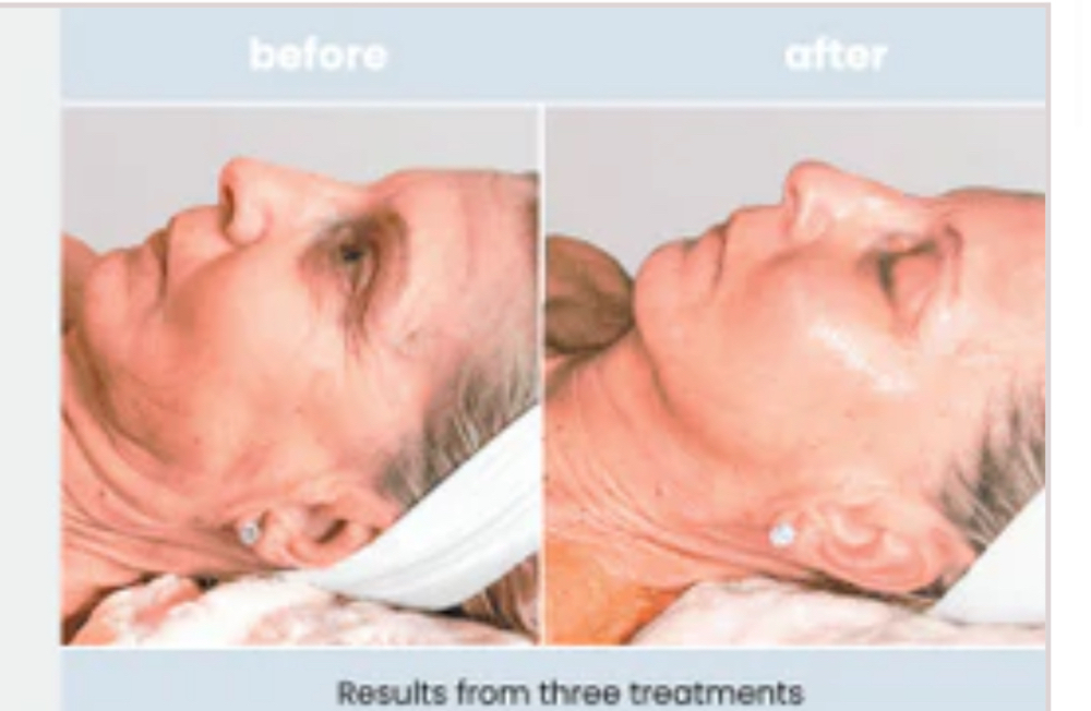 Switch Facial