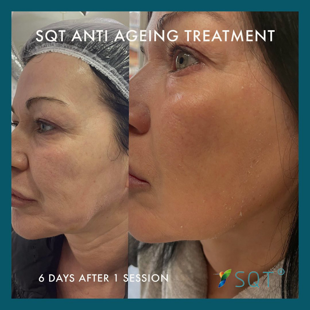 SQT Anti Aging Rejuvenating Treatme