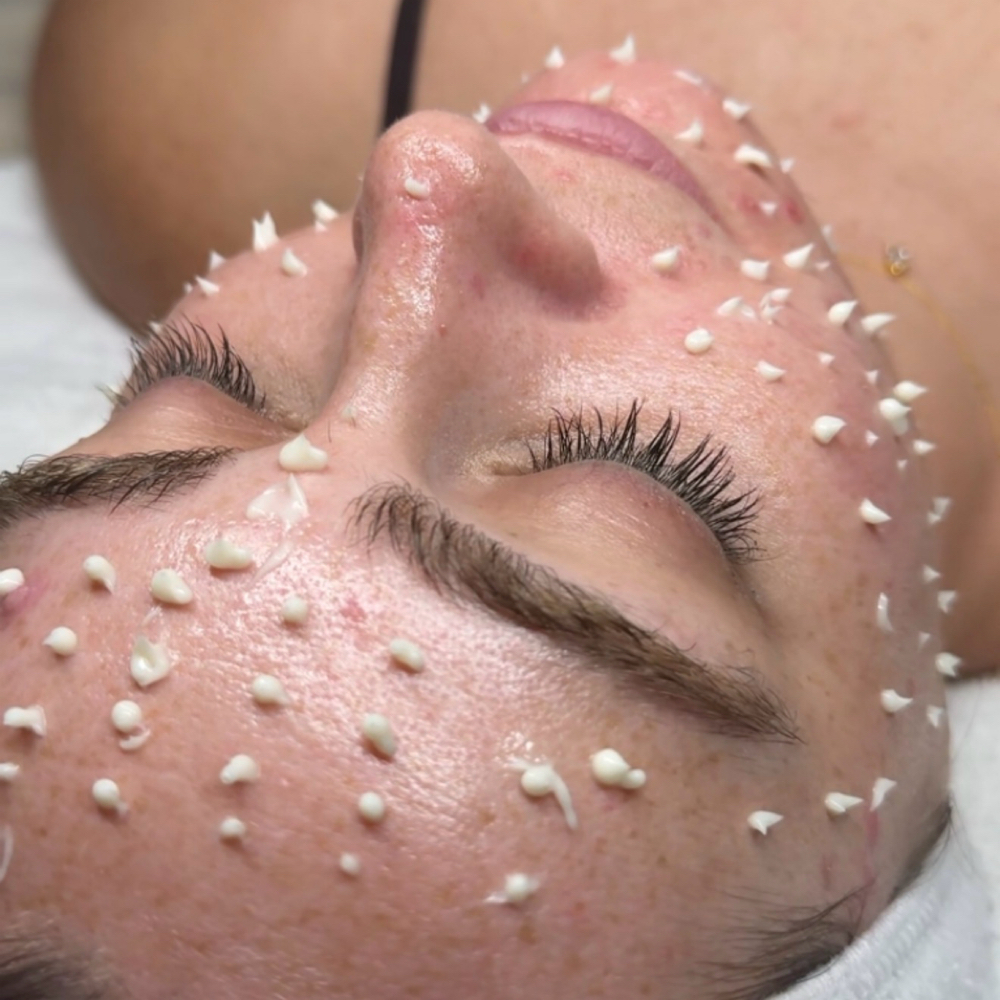 CELLSTORY Liquid microneedling at Skin Alchemy in South Charleston, WV