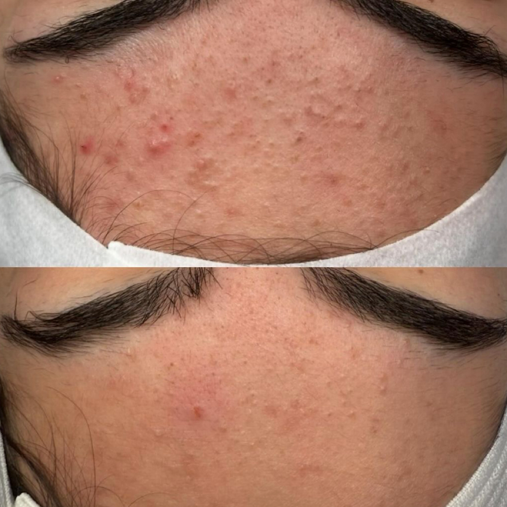 Acne facial at Aries Beauty & Wellness in Chandler, AZ