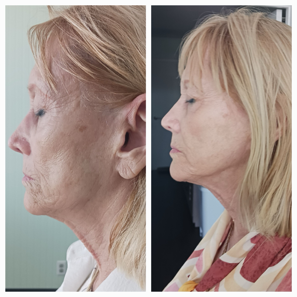 Procell Micro-Channeling Face& Neck at ReNew in Fort Lauderdale, FL