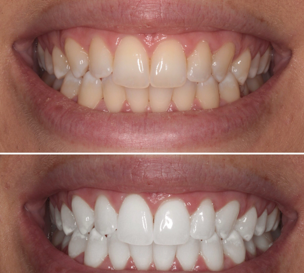 Teeth Whitening