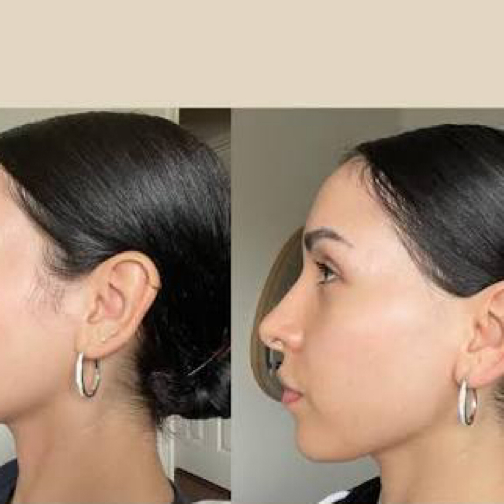 Sideburns Laser - 5 Sessions at Blessed & Bare Laser Studio in New York, NY