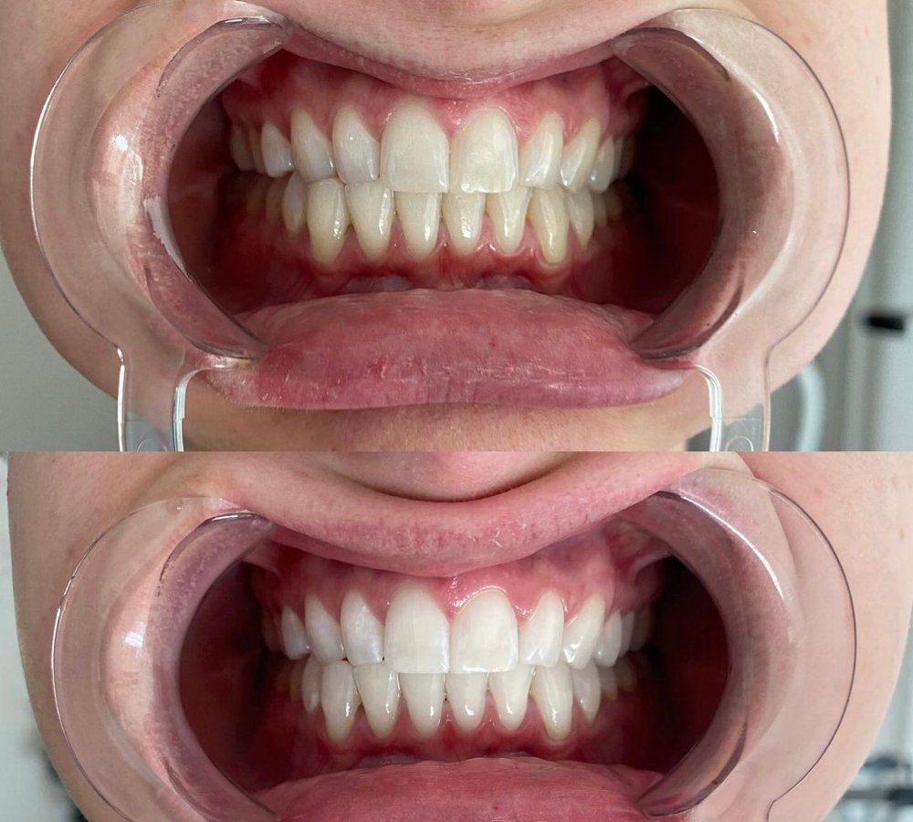 Teeth Whiting