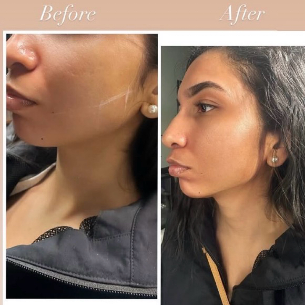 (TMJ) Botox at T&N Skin Med Spa Inc in Abington, PA
