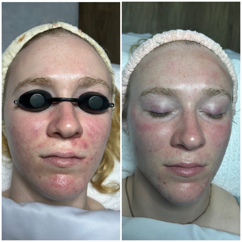 Oxygen Renewal Facial